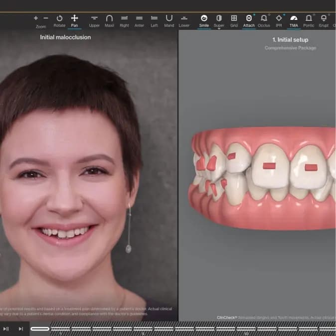 Invisalign® Digital Treatment For Aligners | Invisalign.ca