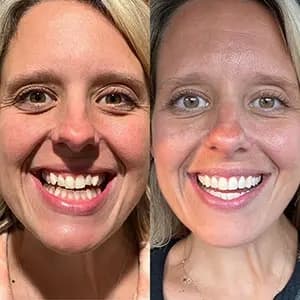 Invisalign Image Before and After Invisalign® | Invisalign Results | Invisalign.ca